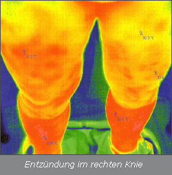 Thermographie Knie